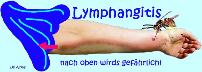 Lymphangitis Rote Streifen Auf Der Haut ifn-berlin.de